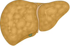 Liver changing color and disfigured relative to Fibrosis Stage 2