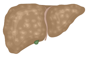 Liver changing color and disfigured relative to Fibrosis Stage 3