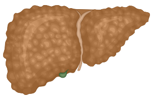 Liver changing color and disfigured relative to Fibrosis Stage 4